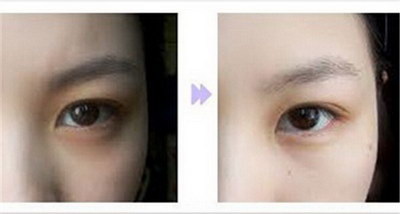双眼皮手术可以做哪几种款式(自然型双眼皮)