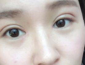 双眼皮全切提肌两只眼睛大小不一样_双眼皮全切一个月伤口疤痕还是红的