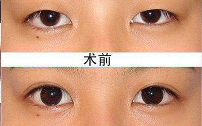 割的双眼皮和自然长的有什么区别_割的双眼皮会变单吗
