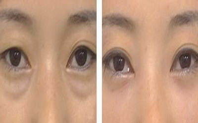 割双眼皮是微调还是整容_割双眼皮手术的注意事项
