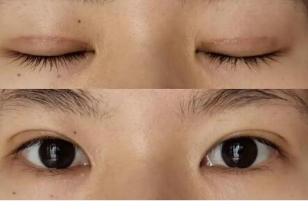 韩式双眼皮和全切有什么区别(韩式双眼皮和全切有什么不一样)