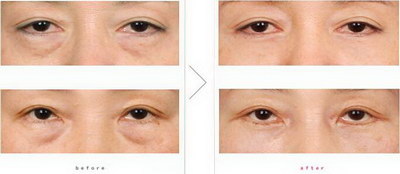 眼综合1到30天恢复图片_眼综合术后发黄怎么快速消除