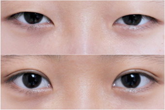 双眼皮手术分哪几种_双眼皮手术风险大吗
