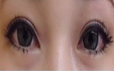 北京双眼皮手术推荐医院_双眼皮手术后要不要包扎