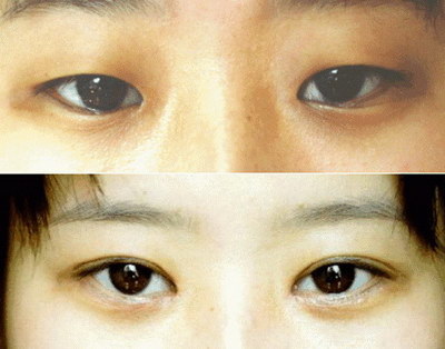 双眼皮全切手术多久能恢复正常_做完双眼皮全切后几天可以上班