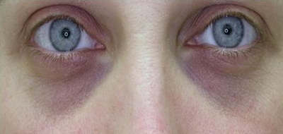 做完双眼皮一个月眼睛有紧绷感正常吗_做完双眼皮一年了疤痕还是明显怎么办