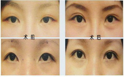 做完双眼皮隆鼻多久可以同房_双眼皮和隆鼻哪个手术难度大