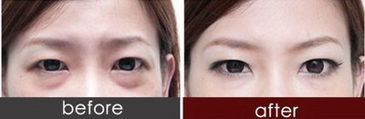 单眼皮怎么可以变双眼皮按摩方法_单眼皮不动手术可以变成双眼皮吗