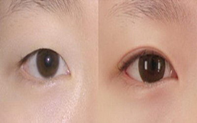 南京双眼皮修复比较好的医生