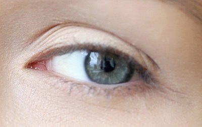 埋线双眼皮一般能维持几年
