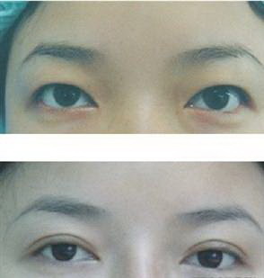 眼袋手术一个月后疤痕凸起增生了(眼袋手术一个月了疤痕还红正常吗)