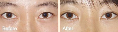 全切双眼皮眼睑外翻是什么原因_全切双眼皮后多久可以纹美瞳线