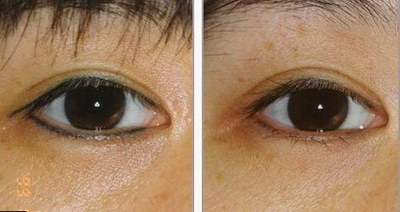 对比分析:埋线双眼皮与三点双眼皮维持时间的差异_无痕双眼皮和埋线双眼皮的区别