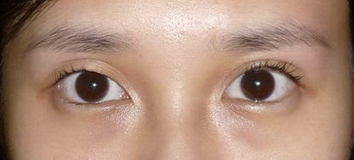 双眼皮割完半个月的效果_双眼皮开扇可以改平行吗