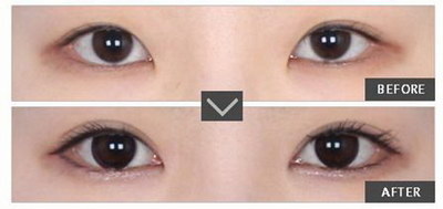 双眼皮手术后眼皮上有小疙瘩_双眼皮手术最好选择哪里去做