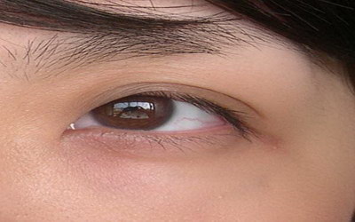 割双眼皮后会有时候看得模糊_割双眼皮后会有眨眼后遗症吗
