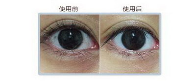 做双眼皮过后要多久才会看起来自然_做双眼皮眼睛手术之后需要注意什么