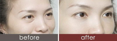 眼综合手术效果对比:腔镜手术与传统手术的比较(眼综合手术效果前后对比)