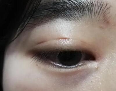 割双眼皮怎样才能恢复的快_割双眼皮多久可以恢复正常