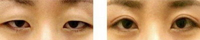双眼皮三点定位和全切有什么区别_双眼皮三点定位适合什么样的眼睛