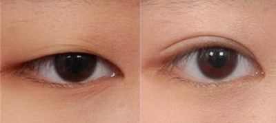 割双眼皮的最佳年龄是多大_割双眼皮第二天发紫正常吗