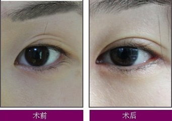 杭州双眼皮手术比较好的医院(杭州哪家医院双眼皮手术做的比较好)