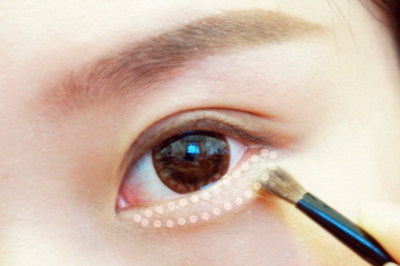 割双眼皮10多天眼角增生怎么办_割双眼皮1个月眼角有白疤
