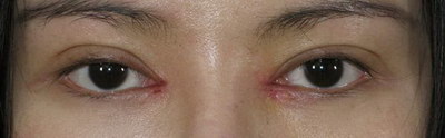 全切双眼皮增生期是多久(什么是全切双眼皮手术？)