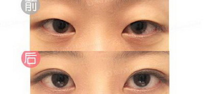 割双眼皮跟埋线双眼皮价位_割双眼皮跟埋线双眼皮有什么区别