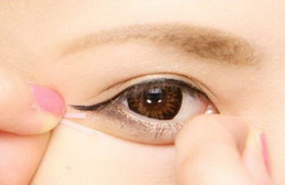 双眼皮手术后怎样预防增生_双眼皮手术五天一直不消肿