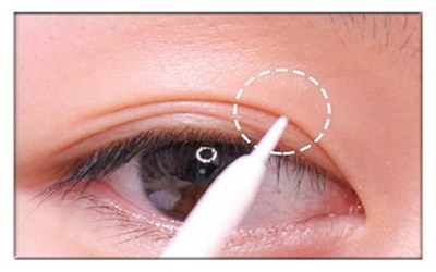 先天性眼皮下垂是怎么造成的【先天性眼皮下垂怎么治疗效果最好】