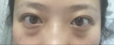 双眼皮手术效果对比图_双眼皮手术后眼皮紫红
