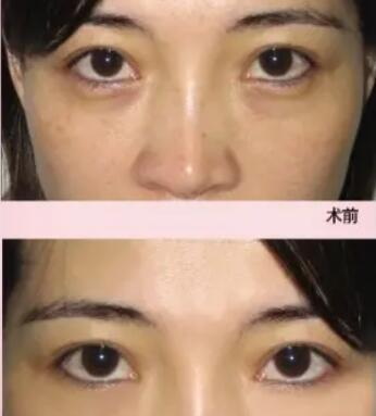 双眼皮手术后怎样预防疤痕_双眼皮手术的疤痕发红正常吗
