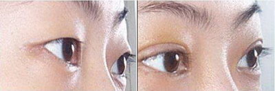 割双眼皮眼睛有肿块怎么办_割双眼皮眼睛淤青多久能消失