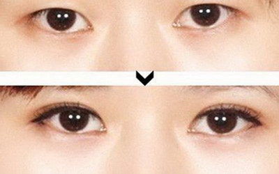 双眼皮手术做窄了怎么办_双眼皮术后疤痕如何修复
