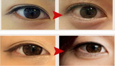 如何有效消除黑眼圈及眼袋(如何消除黑眼圈最有效方法)