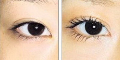做双眼皮恢复过程图案例(全切双眼皮恢复过程图案例)