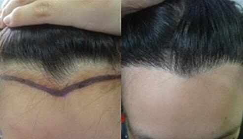 额角植发需要多少单位_额角植发一般需要多少根毛发