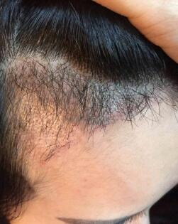 疤痕毛发种植效果如何_疤痕毛发种植特点是什么