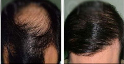 做毛发种植哪里比较好_到哪家毛发种植成效好
