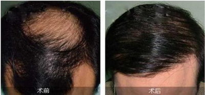 发根浅掉头发什么原因_吃什么能防止掉头发呢