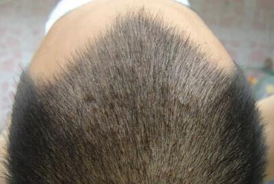 发际线开始长小头发说明什么_发际线可以种植别人的头发吗