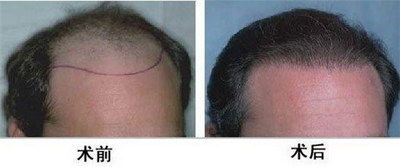 植发后流血痂怎么处理_植发后毛囊炎反复发作