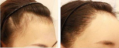 头发种植成活率有多高_头发种植能保持多久时间