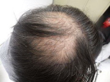 想学种植头发技术去哪里学_种植头发的效果能保持多久