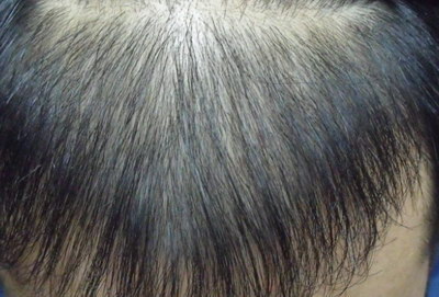 发际线植发后多久可以戴帽子_发际线植发大概需要多少毛囊