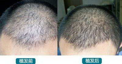 做头发种植手术的价位_南京头发种植哪里可以
