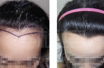 发际线高种植头发是否有用_发际线高的可以种植头发吗
