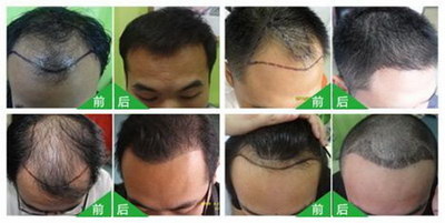 十六岁男生掉头发严重_发膜可以防止掉头发吗