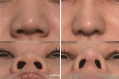 鼻子拆线后多久可以做面膜_鼻子可以出气但是不能吸气